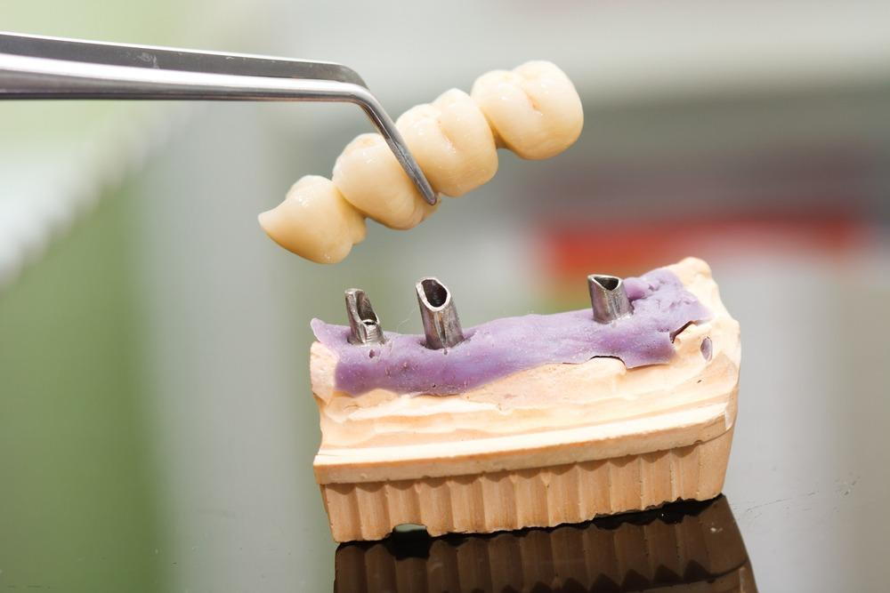 Close-up of custom dental crowns and bridge being prepared for a restorative procedure.